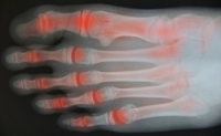 Eight Symptoms of Toe Arthritis