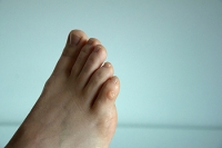 Types and Causes of Foot Corns